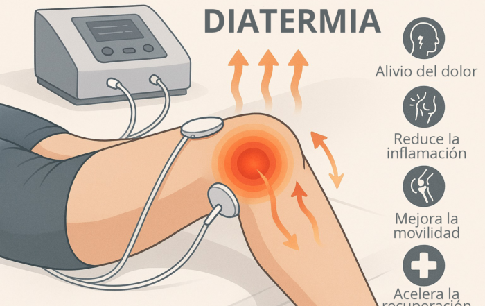 Diatermia y sus beneficios
